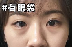 -广州健丽·去眼袋医疗美容机构