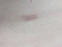 -成都军建医院·疤痕诊疗中心