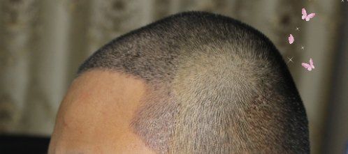 -大麦微针植发丨全国连锁