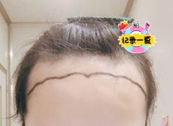 -大麦微针植发全国连锁