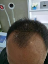 -大麦微针植发全国连锁