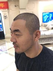 -大麦微针植发丨全国连锁