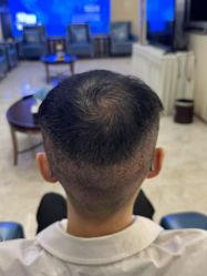 点击看大图 -大麦微针植发丨全国连锁
