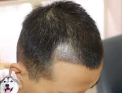 -大麦微针植发丨全国连锁