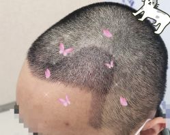 -大麦微针植发全国连锁