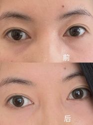 -广州健丽·去眼袋医疗美容机构