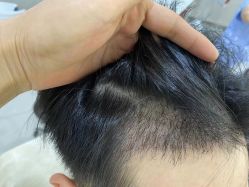 -大麦微针植发全国连锁