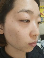 -北京美痣堂古方祛痣斑疣瘊