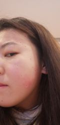 -美丽人生祛斑扁平疣汗管瘤中心