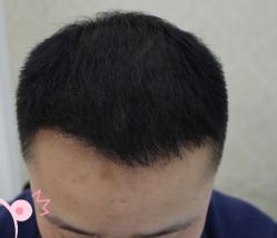 -大麦微针植发丨全国连锁