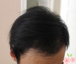 -大麦微针植发丨全国连锁