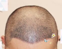 -大麦微针植发全国连锁