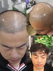 -大麦微针植发全国连锁