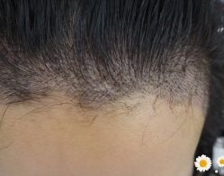 -大麦微针植发丨全国连锁