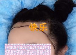 -大麦微针植发全国连锁