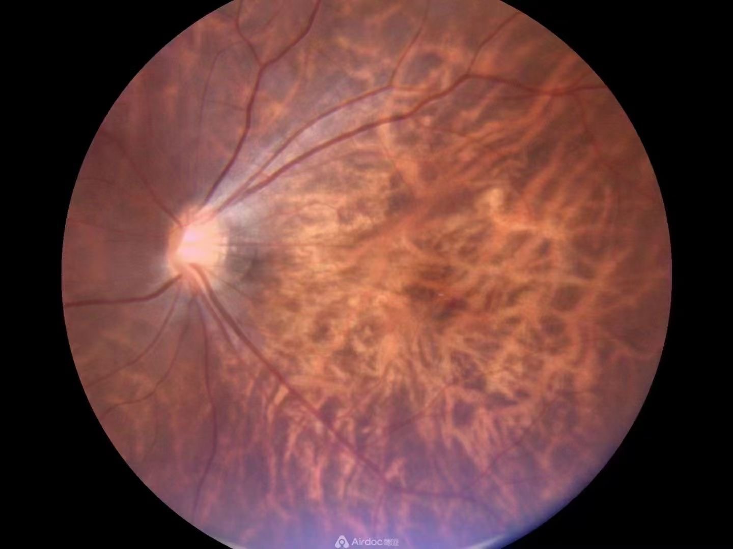 今日看到的眼底图片 这豹纹状