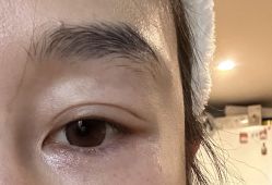 体验后-依萱绮医疗美容