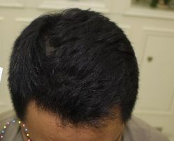 -大麦微针植发丨全国连锁