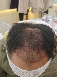 点击看大图 -碧莲盛·不剃发植发