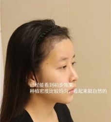 -大麦微针植发丨全国连锁