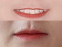 体验前-深圳米兰柏羽医疗美容医院