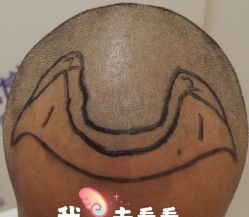 -大麦微针植发全国连锁