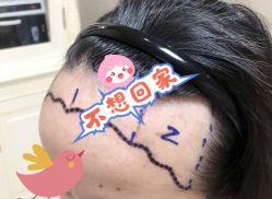 -大麦微针植发全国连锁