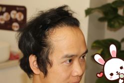 -大麦微针植发丨全国连锁