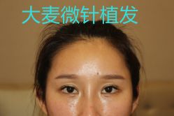 -大麦微针植发丨全国连锁