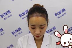 点击看大图 -大麦微针植发丨全国连锁