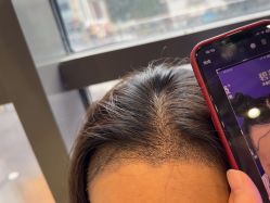 -碧莲盛·不剃发植发