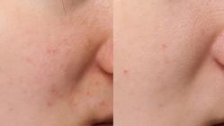 -苑苑vbeauty科技美容SPA
