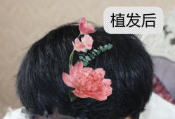 -大麦微针植发全国连锁
