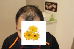 -大麦微针植发丨全国连锁