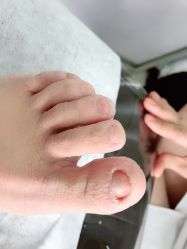 点击看大图 -德哥灰指甲脚气甲沟炎跖疣护理