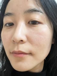 点击看大图 体验后-青岛诺德医学美容医院