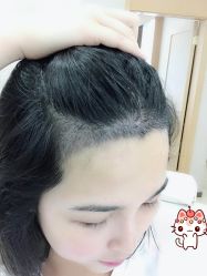 -大麦微针植发丨全国连锁