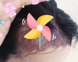 -大麦微针植发全国连锁