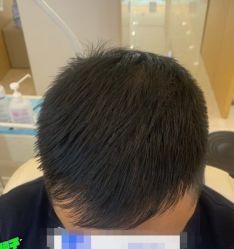 -大麦微针植发丨全国连锁