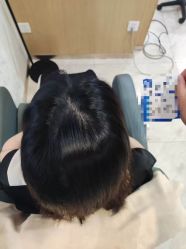 -大麦微针植发丨全国连锁