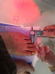 -派恩宜灰指甲鸡眼嵌甲手足癣