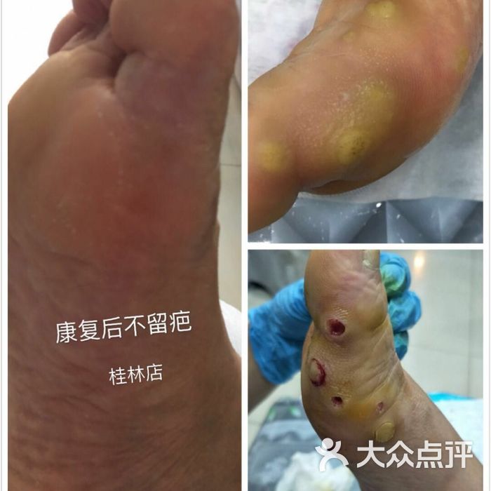 德哥灰指甲腳氣甲溝炎蹠疣護理