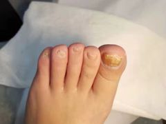 -世龙世家灰指甲鸡眼脚气甲沟炎跖疣护理(通州店)