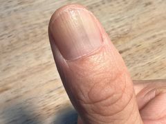 -Andrew指甲专科灰指甲·甲沟炎矫正·3D步态矫形鞋垫定制(上海法华镇路旗舰店)