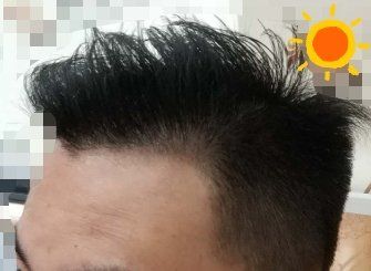 -大麦微针植发丨全国连锁