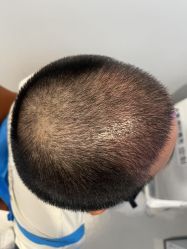 -大麦微针植发全国连锁