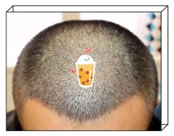 -大麦微针植发全国连锁