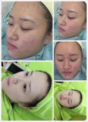 祛痘效果-苗方清颜专业祛痘