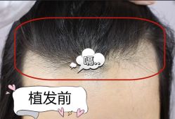 -大麦微针植发全国连锁