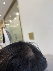-碧莲盛·不剃发植发
